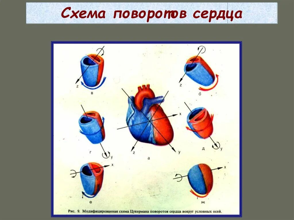 Поворот сердца вокруг продольной оси. Повороты сердца на ЭКГ вокруг продольной оси. Повороты сердца вокруг оси на ЭКГ. Повороты сердца на ЭКГ. Поворот правым желудочком вперед