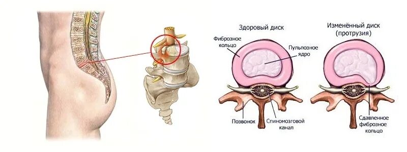 Болит ли протрузия. Протрузии позвонков поясничного отдела. Протрузия крестцового отдела позвоночника. Протрузия межпозвонковых дисков. Протрузия дисков позвоночника поясничного отдела гимнастика.
