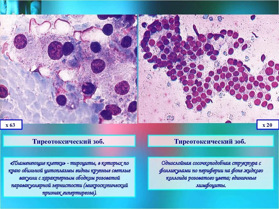 Цитологическая диагностика заболеваний щитовидной железы. Тиреотоксический Узловой зоб. Заболевания щитовидной железы. Тиреотоксический зоб..