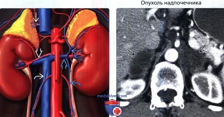 Лимфоузлы надпочечников. Кт почек и надпочечников. Кт сосудов почек и надпочечников.