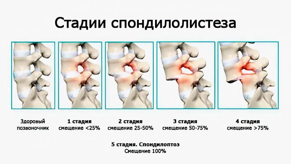 Смещение 5