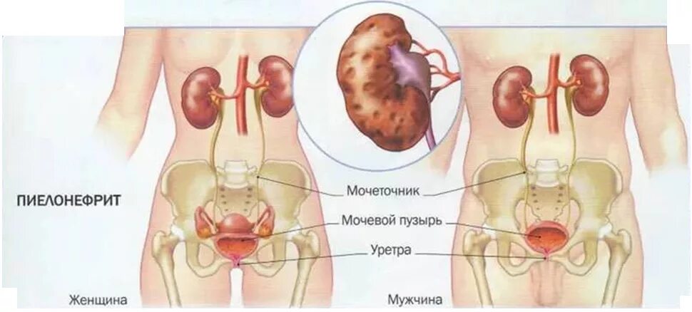 Пиелонефрит у девочек. Мочекаменная болезнь хронический пиелонефрит. Хронический пиелонефрит вид почки. Острый и хронический пиелонефрит симптомы. Пиелонефрит поражение почечной лоханки.