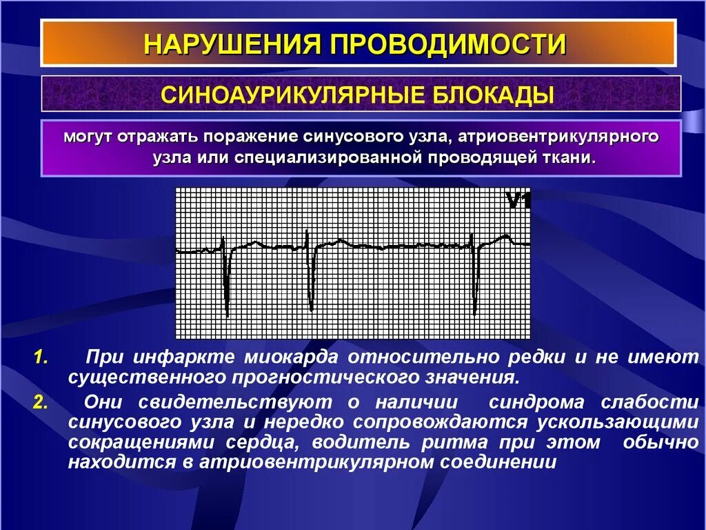 Синоаурикулярная блокада. Синдромы нарушений проводимости ЭКГ. Формы нарушения проводимости миокарда. Нарушение сердечной проводимости. Нарушение функции проводимости сердца.