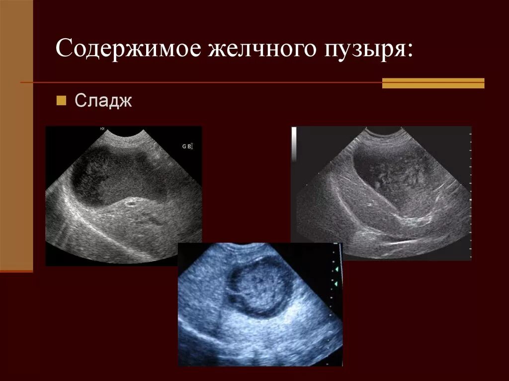 Сморщенный желчный пузырь. Сладж-синдром желчного пузыря на УЗИ. УЗИ камни взвесь в желчном пузыре. Взвесь в желчном пузыре на УЗИ. Сладж феномен желчного пузыря.