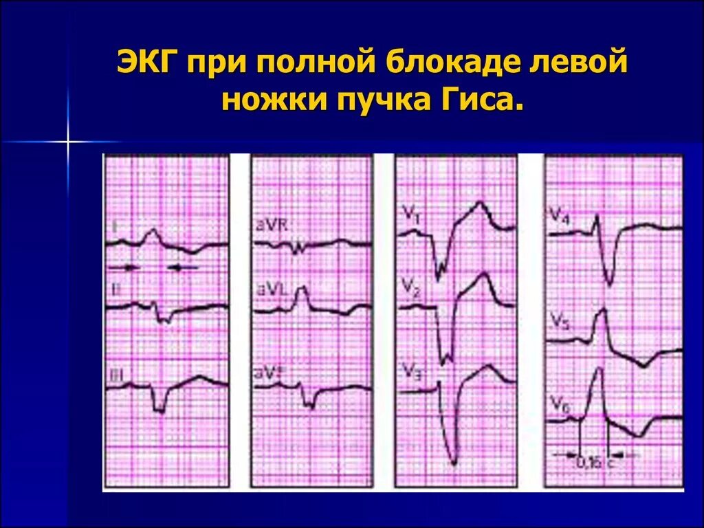 Блокада левой ножки п гиса. ЭКГ при блокаде пучка Гиса. Блокада левой ножки пучка Гиса на ЭКГ. ЭКГ при блокаде левой ножки пучка Гиса. Блокада левой и правой ножек пучка Гиса на ЭКГ.