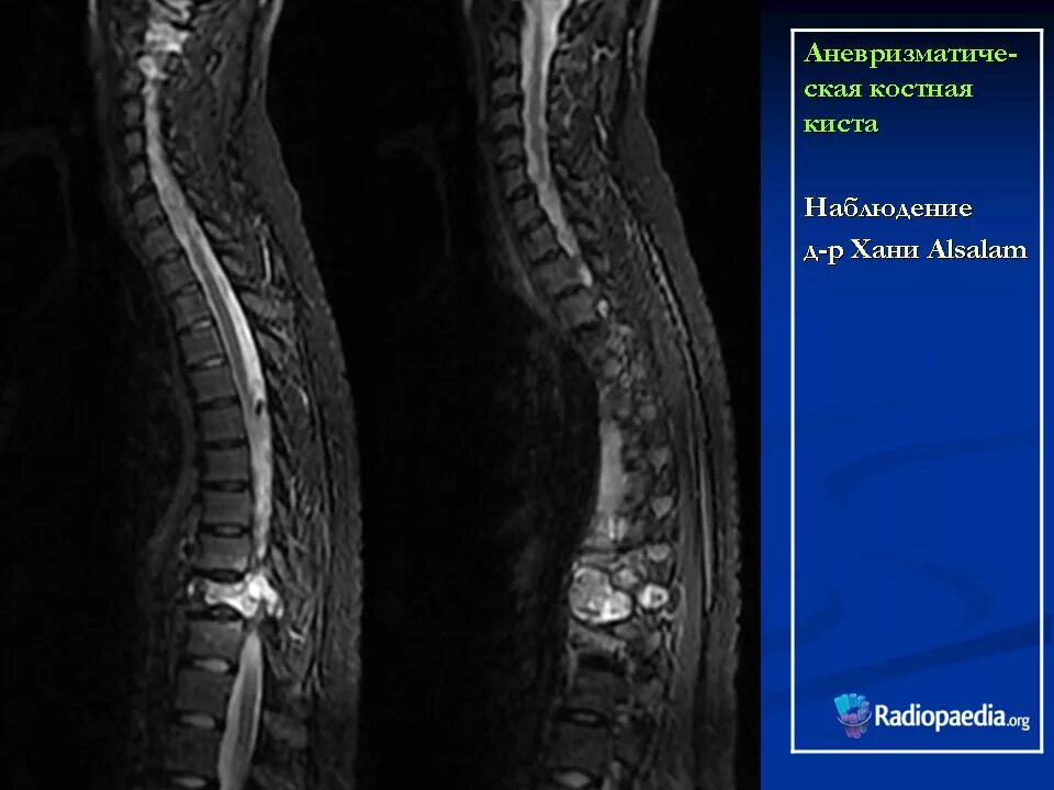 Аневризмальная костная киста позвоночника мрт. Периневральная киста грудного отдела позвоночника на мрт. Периневральные кисты позвоночника. Аневризматическая костная киста позвонка мрт. Операция кисты позвоночника