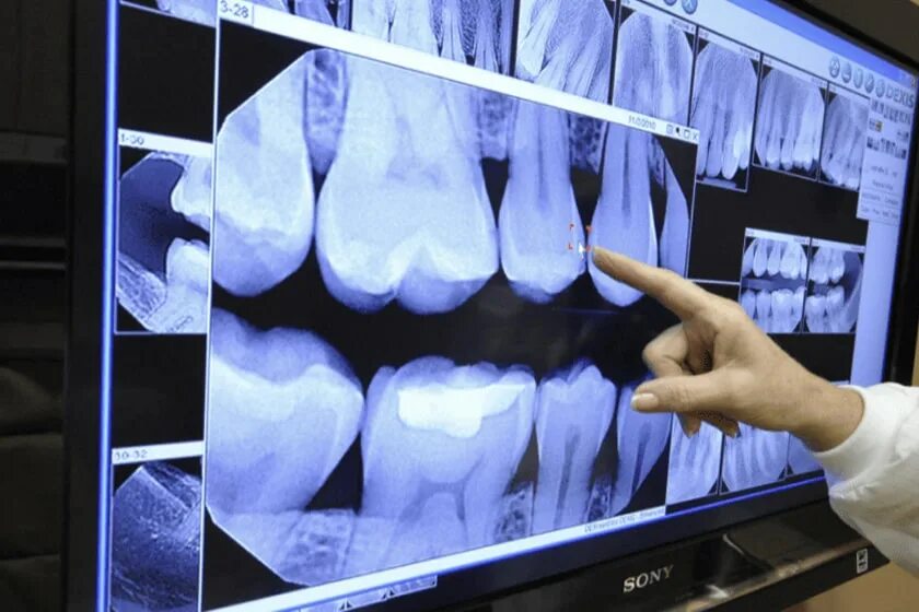 Снимок. Внутриротовая рентгенография зубов. Dental визиограф XRAY. Рентгенография лучевая диагностика.