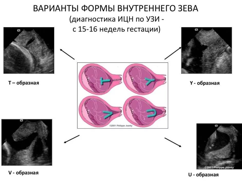 Ультразвуковые критерии ИЦН. Критерии истмико цервикальной недостаточности по УЗИ. V образное расширение внутреннего зева шейки матки при беременности. Y образная форма внутреннего зева. Шейка в 12 недель