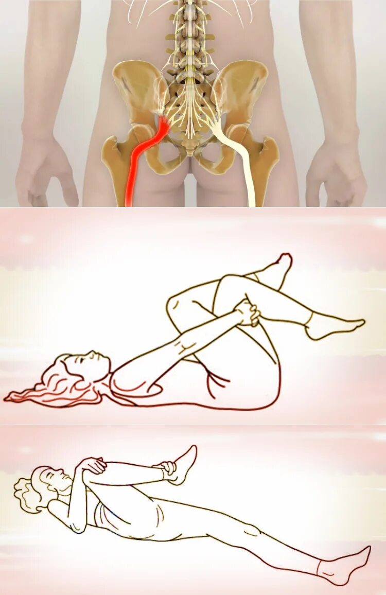 Седалищный нерв гимнастика. Защемило седалищный нерв. Защемление седалищного нерва. Ишиас седалищного нерва. Болит поясница и левая нога