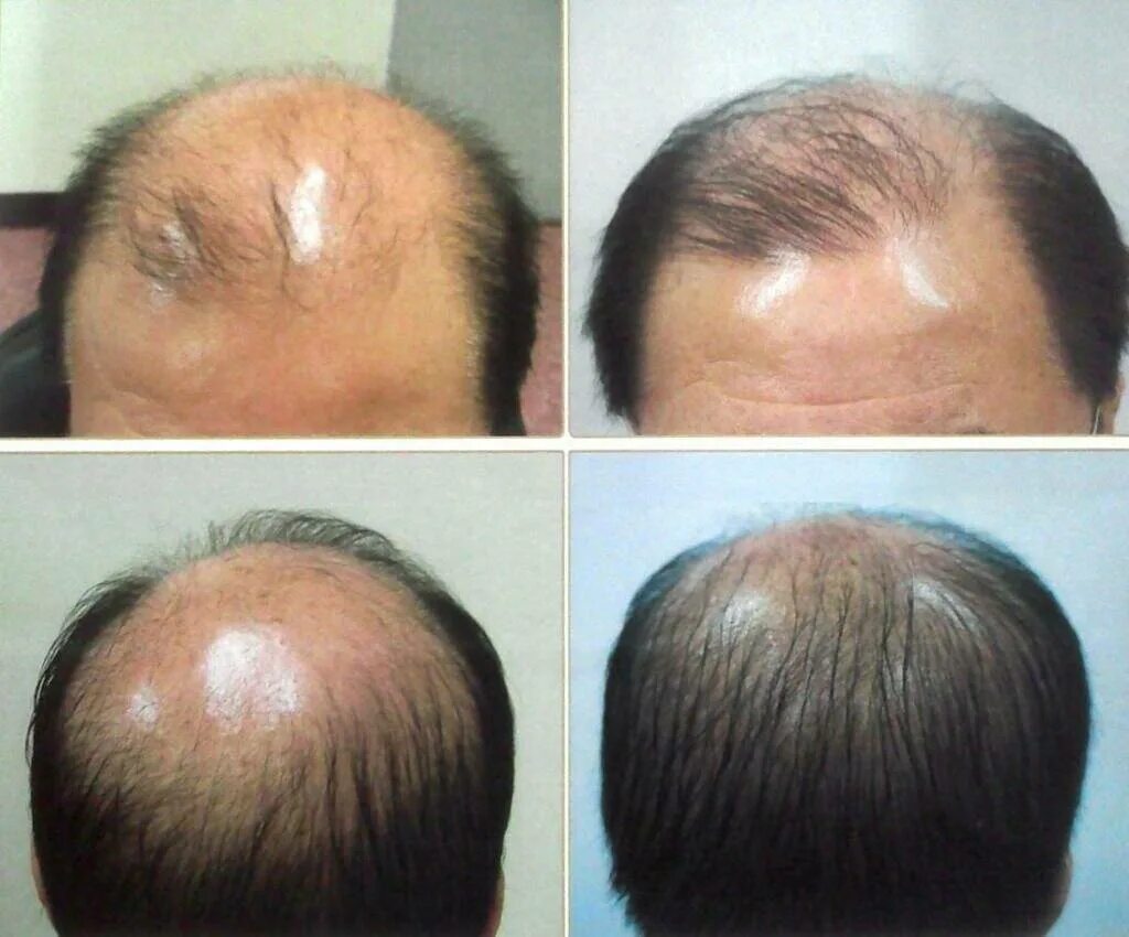 Восстановление выпадения волос. Дарсонваль алопеция андрогенная.