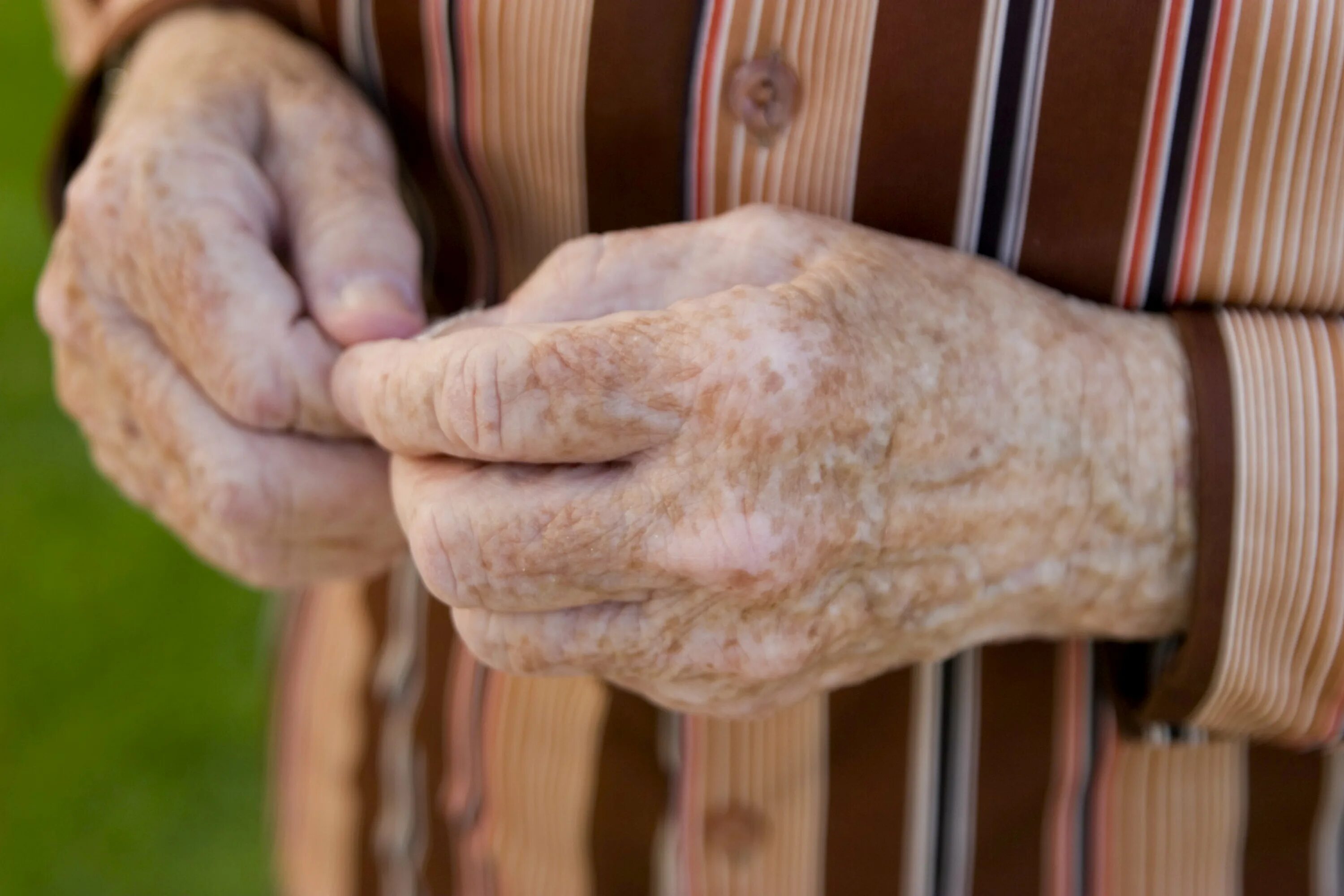 хлоазма,лентиго,мелазма. старческий (солнечный, актинический) кератоз. пигментные пятна нарукаъх. пятна на руках пожилых людей. старческое лентиго на руках.