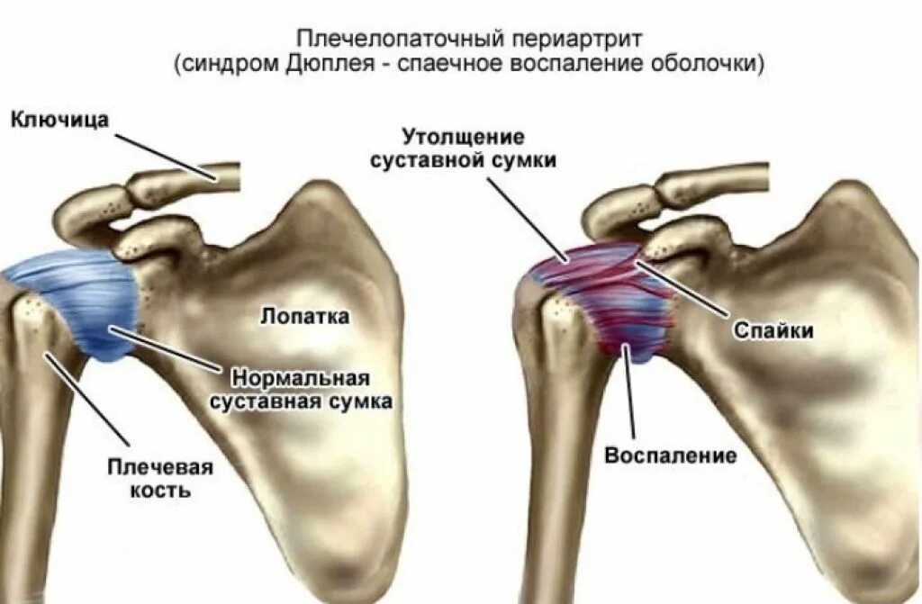 Сильная боль в плечевом суставе