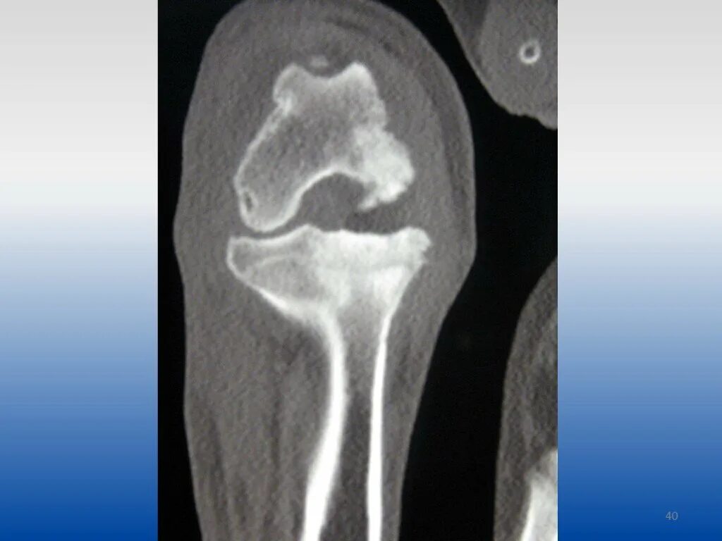 Артрит кт. Септический артрит рентген. Рентгенологическая картина септического артрита. Инфекционный артрит презентация.