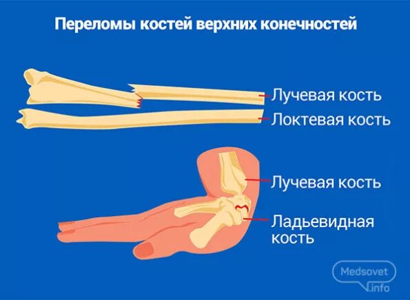 Типичные переломы верхних конечностей. Перелом костей верхней конечности. типичные места переломов верхних конечностей. типичные переломы для костей верхней конечности.