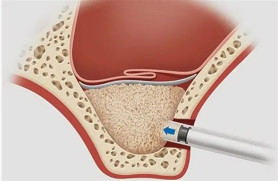Открытый синус лифтинг. Синус лифтинг в стоматологии что такое. Закрытый синус лифтинг в стоматологии.