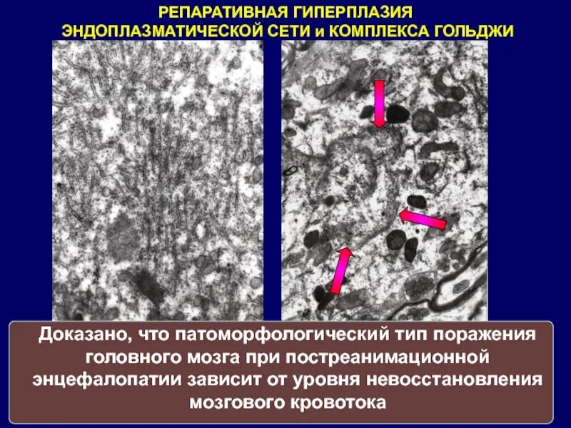 Постгипоксические изменения головного. Постреанимационная энцефалопатия. Гиперплазия эндоплазматической сети. Постаноксическая энцефалопатия патологическая анатомия. Гиперплазия патологическая анатомия.