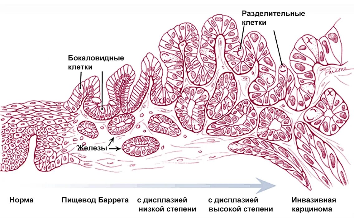 Пищевод Барретта гистология. Пищевод Барретта метаплазия. Пищевод Барретта дисплазия. Пищевод Барретта патанатомия. Клетки пищевода