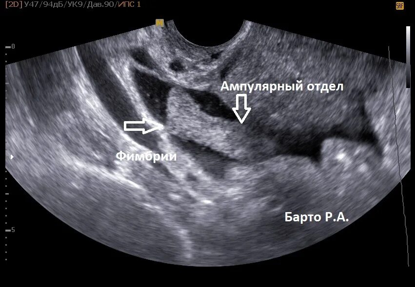 УЗИ проходимости маточных труб. Расширенная маточная труба на УЗИ. На узи видна труба