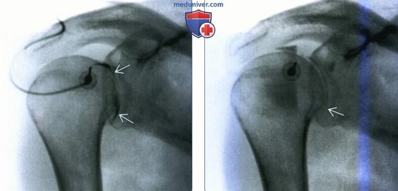 Как лечить капсулит. Капсулит плечевого сустава рентген. Капсулит плечевого сустава мрт. Адгезивный капсулит плеча рентген. Оссифицирующий капсулит плечевого сустава мрт.