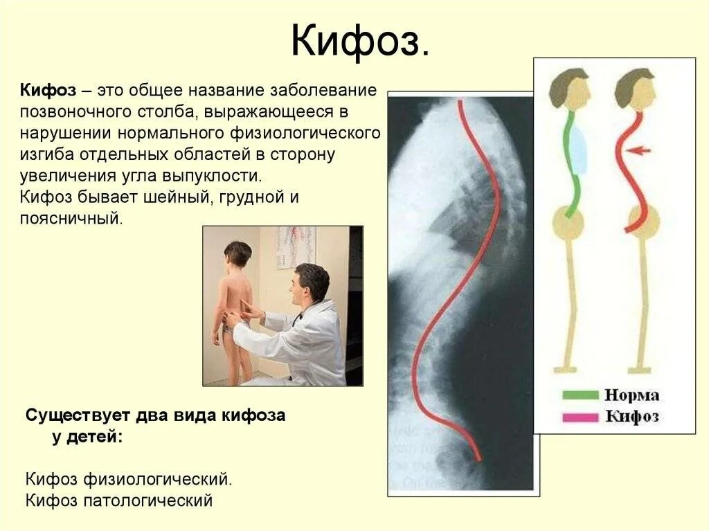 Физиологический кифоз грудного отдела. Патологический грудной кифоз. Кифоз грудного отдела позвоночника 3 степени. Физиологический кифоз грудного отдела позвоночника норма.