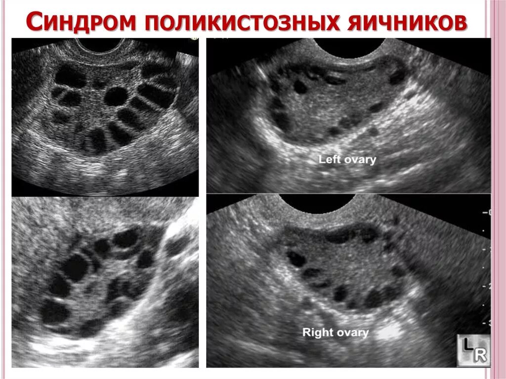 Синдром поликистоза яичников на УЗИ. УЗИ мультифолликулярных яичников. Фолликулярный поликистоз яичников. Снимок УЗИ поликистоз яичников. Лечение фолликулов