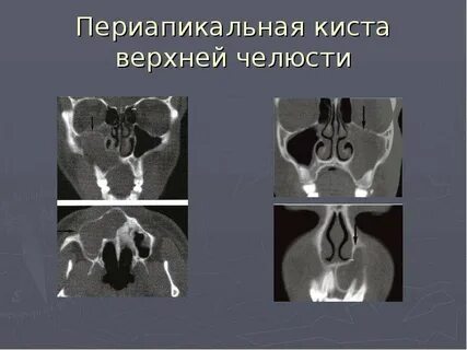 Киста на кт