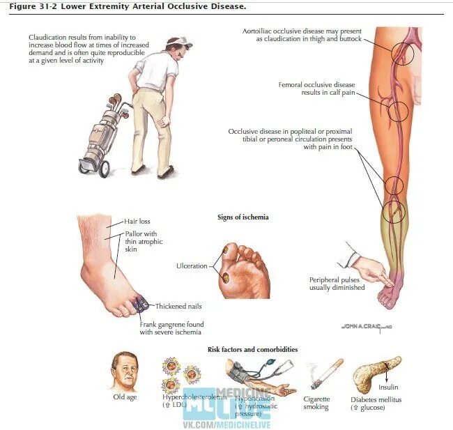 Окклюзионная артерия. Окклюзионные заболевания нижних конечностей. Окклюзионные заболевания сосудов конечностей. Окклюзионное заболевание сосудов конечностей что это. Окклюзионные заболевания сосудов конечностей фото.