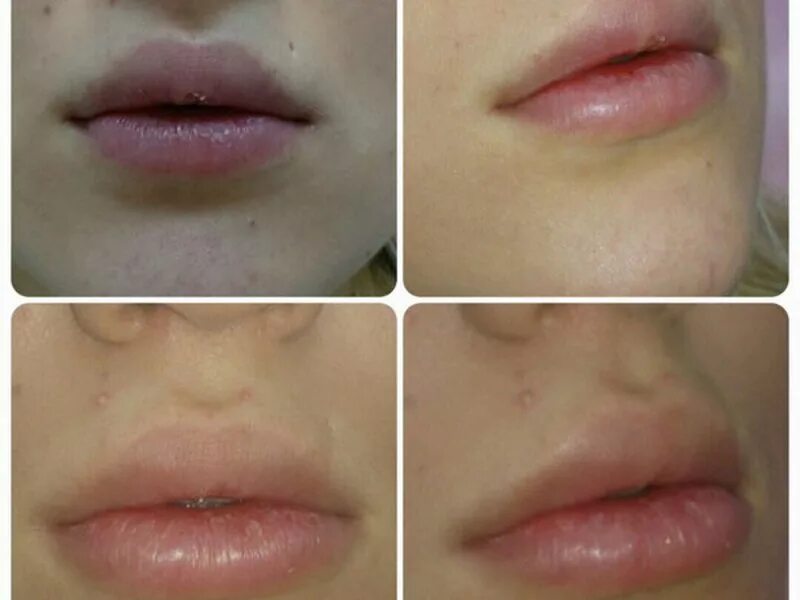 Как правильно разминать губы. Увеличение губ Juvederm Ultra 3.