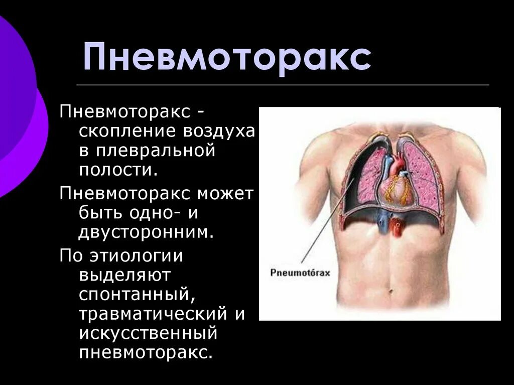 Заболевания грудной полости. Пневмоторакс механизм нарушения дыхания. Открытый пневмоторакс дыхание. Заболевания при пневмотораксе.