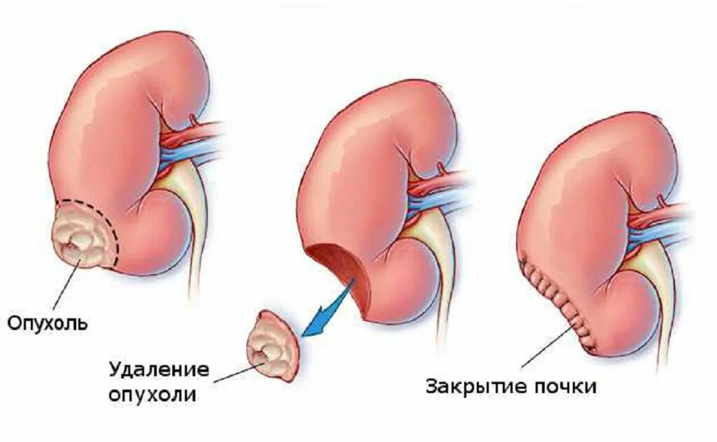 Можно ли удалить почки. Почки. Лапароскопическая резекция опухоли почек. Резекция почки операция. Радикальная нефрэктомия почки.