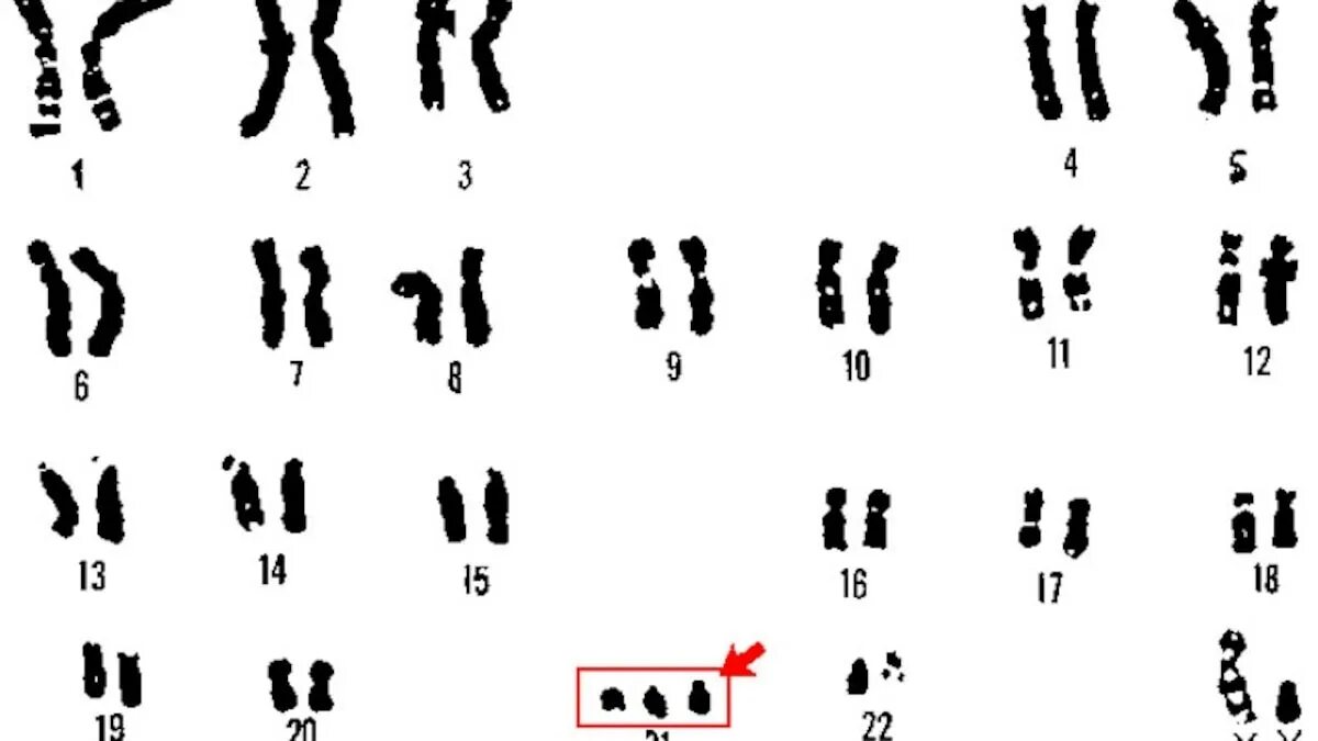 Кариотип человека с синдромом Дауна. Набор хромосом у человека с синдромом Дауна. Синдром Дауна (трисомия по 21 паре хромосом). Мышечная дистрофия Дюшенна кариотип. Наличие лишней хромосомы