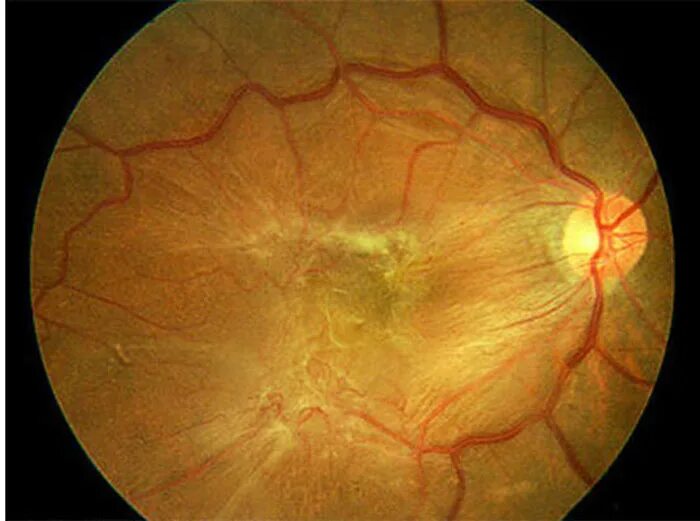 Эпиретинальный фиброз глаза. Эпиретинальная мембрана сетчатки. Эпиретинальная мембрана глазное дно. Эпиретинальный фиброз.