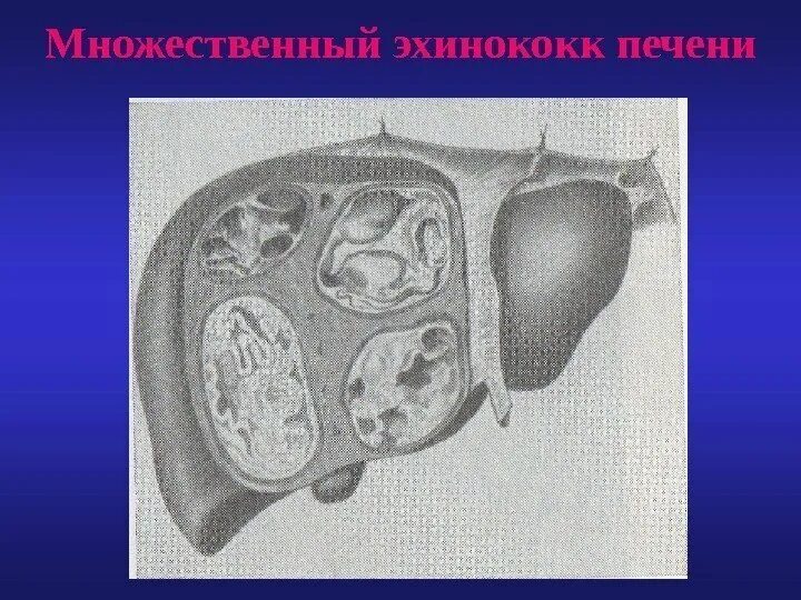 Эхиноккоз