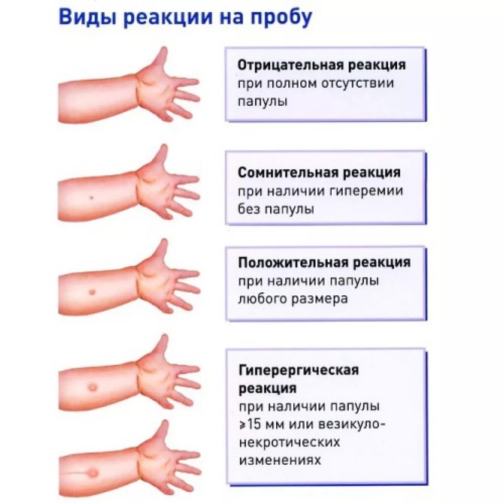 Для чего нужны пробы. Туберкулиновая проба реакция манту. Прививка манту в 1 год реакция норма у детей. Какая должна быть реакция на манту у ребенка в 7 лет норма. Диаскинтест Размеры норма у детей.