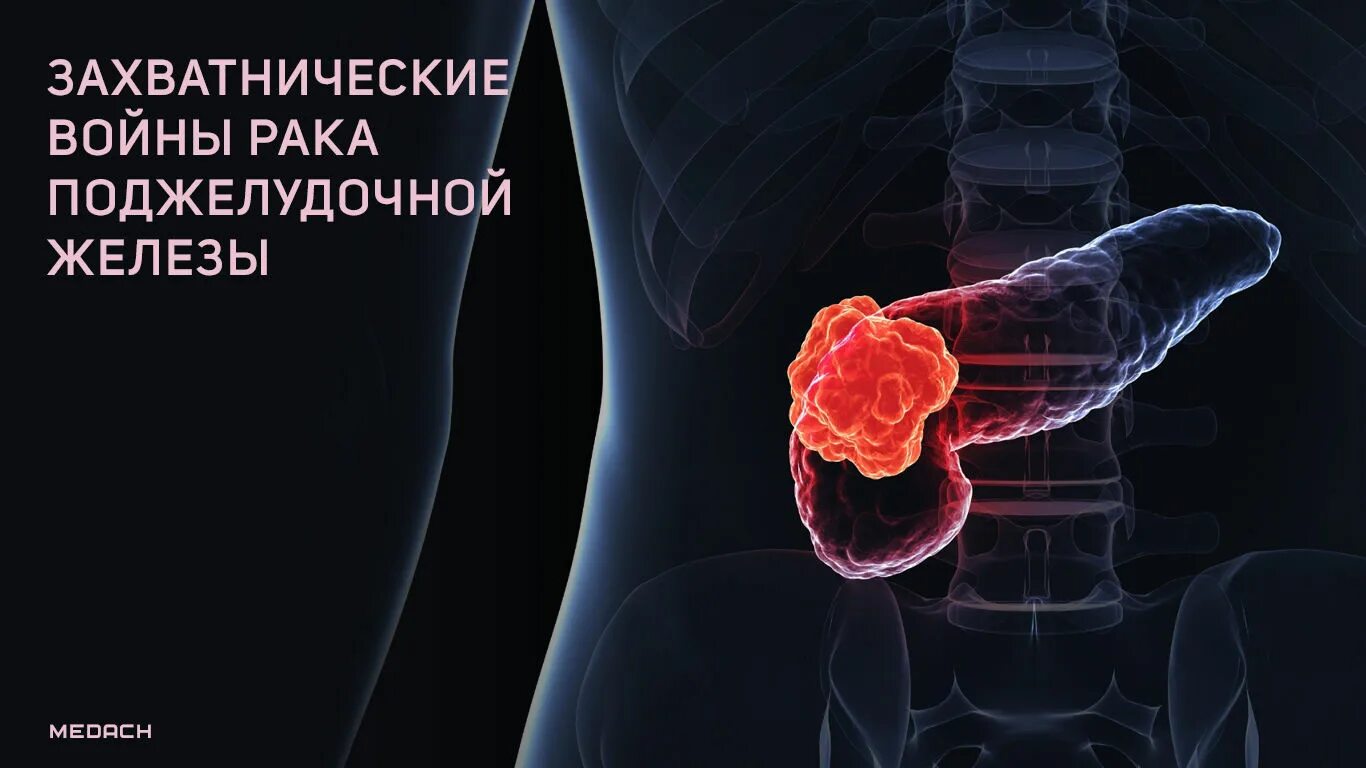 4 стадия поджелудочной железы сколько живут. Опухоль в поджелудочной железе. Раковая опухоль поджелудочной железы. Злокачественные новообразования поджелудочной железы. Онкология поджелудочной.