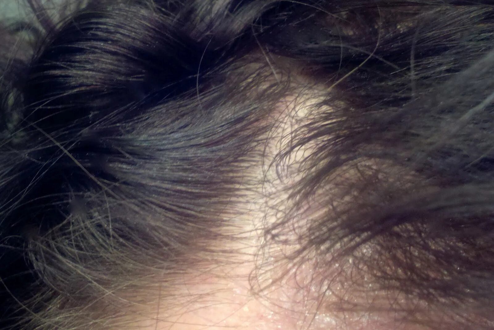 Dermatitis of the scalp pictures Symptoms and pictures