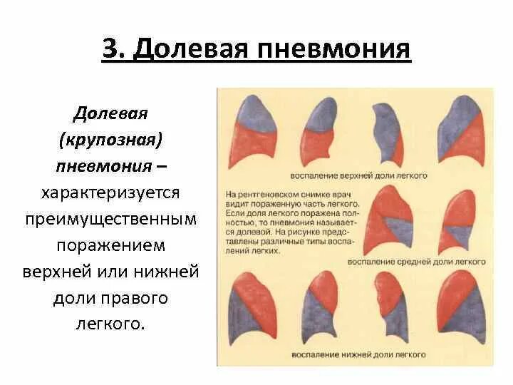 Долевая пневмония рентген. Что поражается при долевой пневмонии?. Аускультативный признак долевую пневмонию. Изменения в верхней доле легкого