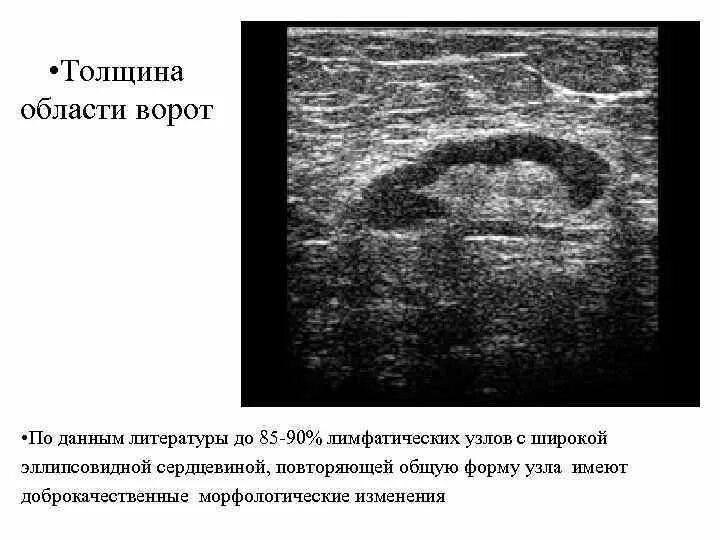 Ворота печени лимфатические узлы. Ворота лимфатического узла на УЗИ. Лимфоузлы ворот печени на УЗИ. УЗИ селезенки лимфатических узлов. Увеличенные лимфоузлы в печени