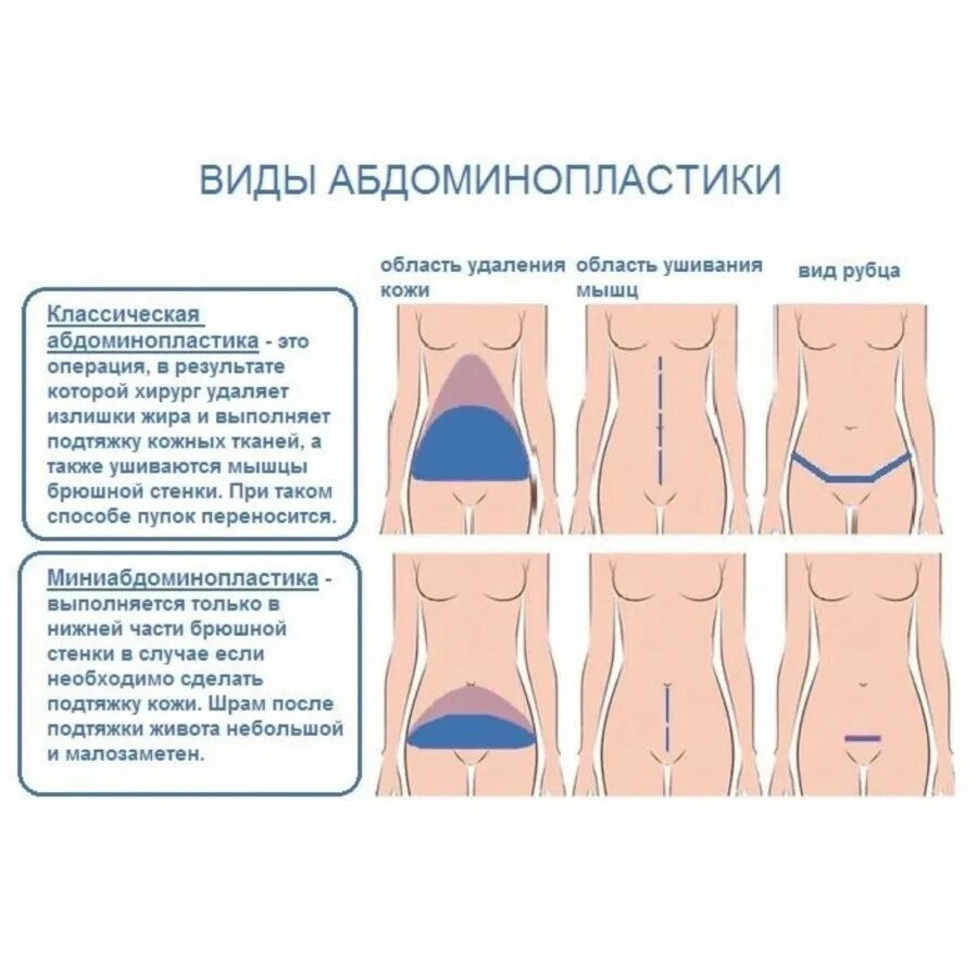 Сколько времени надо после операции. Операция абдоминопластика живота после операции. Пластика живота (абдоминопластика) (2 схема). Вертикальная абдоминопластика техника операции схема. Миниабдоминопластика схема операции.