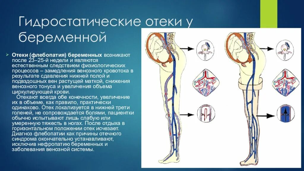 Отекаю после беременности. Гидростатический отек. Отеки вызванные беременностью. Отеки беременных диагноз.