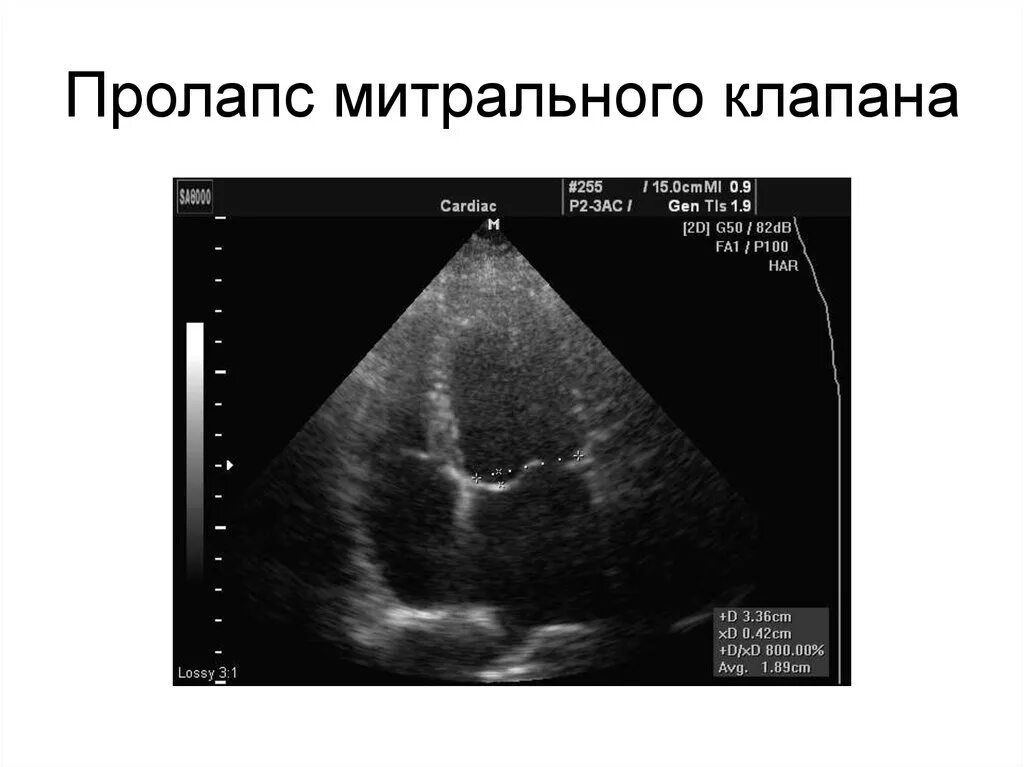 Что такое пролапс митрального клапана. Пролапс трикуспидального клапана на УЗИ. Створки митрального клапана на УЗИ. Пролапс створок митрального клапана. Пролапс митрального клапана эхокардиография.