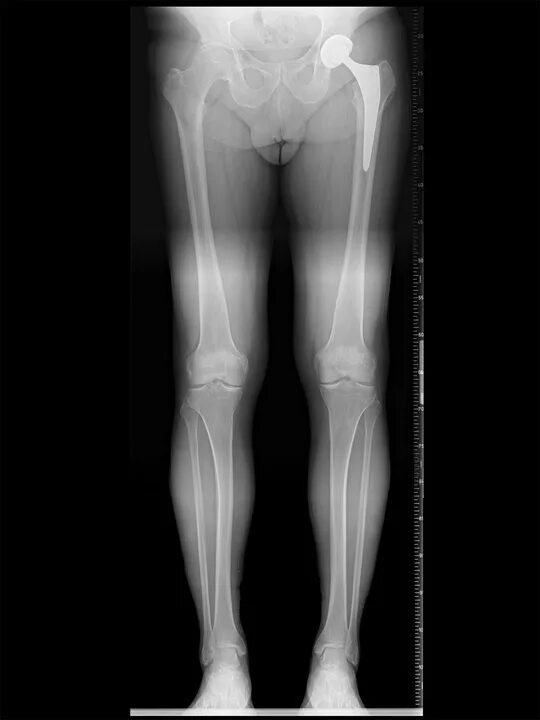 Рентген костей голени норма. Рентгенограмма голени - норма. Топограмма нижних конечностей рентген. Рентген сшивка нижних конечностей.