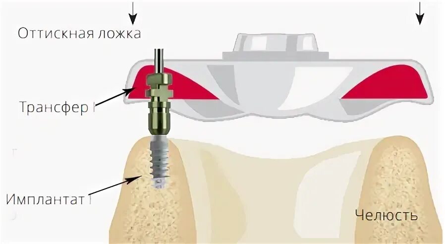 Слепочный трансфер. Странсферы для имланта.