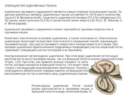 Ущемленная пупочная грыжа
