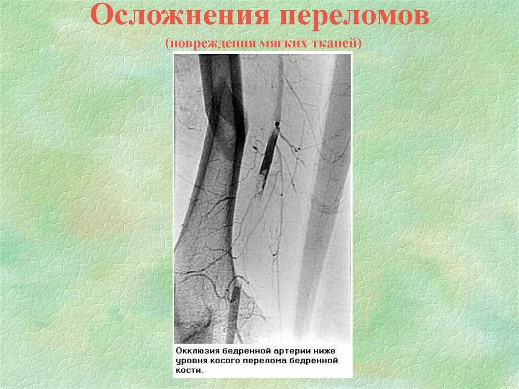 Осложненные и неосложненные переломы. Обширные повреждения мягких тканей. Осложнения переломов костей. Последствия трещины