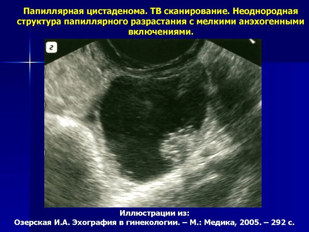 Муцинозная опухоль яичника на УЗИ. Муцинозная папиллярная опухоль яичника. Серозная папиллярная грубососочковая цистаденофиброма яичника. Цистаденокарцинома яичника на УЗИ. Рак после удаления яичников