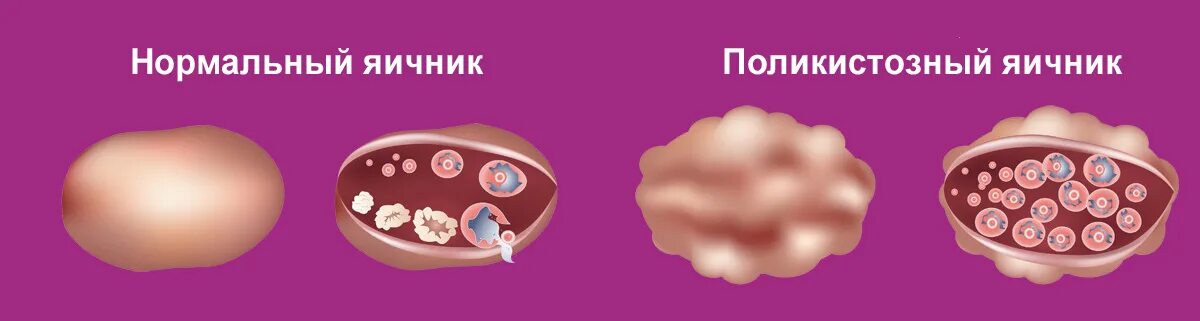Синдром поликистоза яичников симптомы. Первичный поликистоз яичников. Синдром поликистоза яичников клиника. ПКЯ – поликистозные яичники.