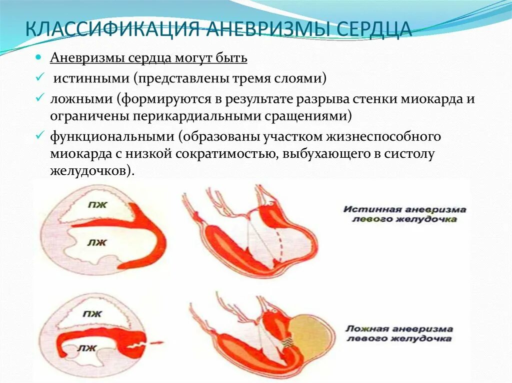 Постинфарктная аневризма сердца патогенез. Постинфарктная аневризма сердца клиника. Аневризма сердца классификация. Классификация аневризм сердца. Аневризма сердца что это такое симптомы