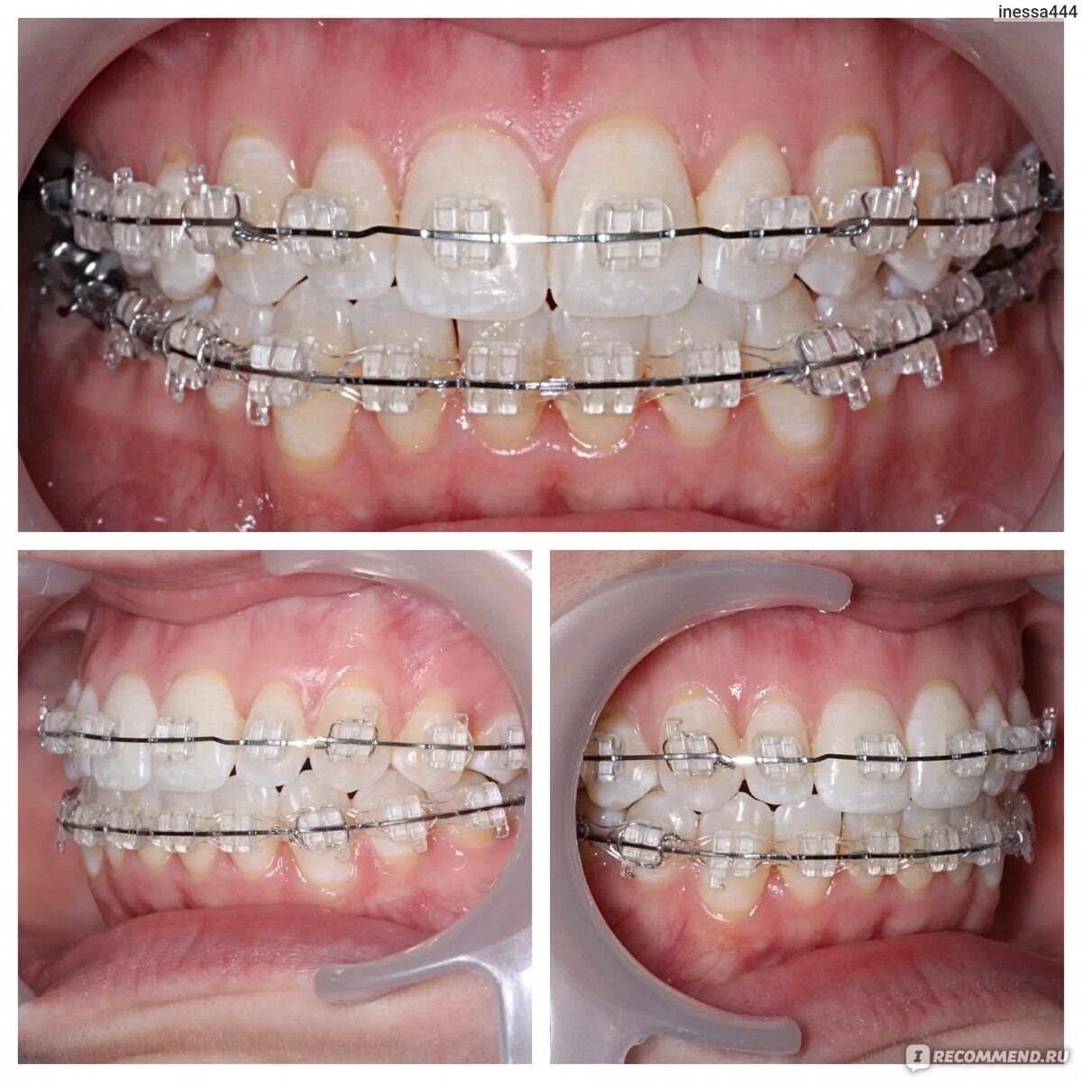 Сколько времени носят брекеты. Брекеты челюсти нижнее сбоку. Самоподтягивающиеся брекеты.