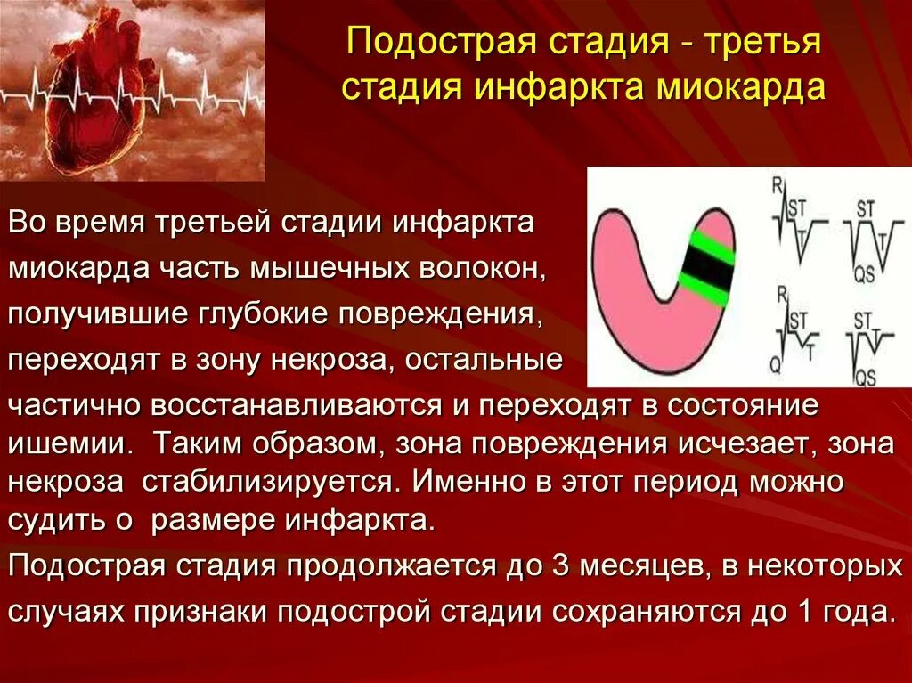 Варианты острого инфаркта миокарда